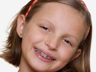 Διαβάστε τους λόγους για τους οποίους το παιδί σας πρέπει να βάλει σιδεράκια